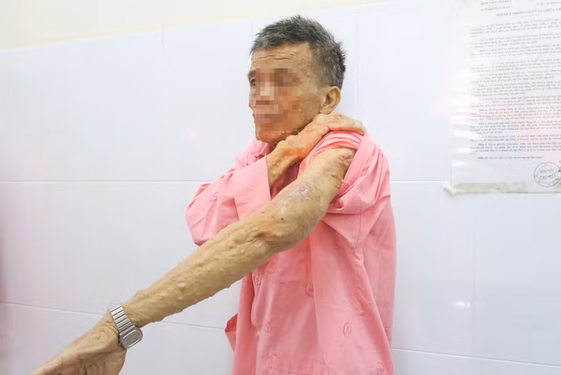 Bệnh nhân cảm thấy nhẹ nhõm, sinh hoạt thuận tiện hơn sau khi được phẫu thuật cắt bỏ khối u bướu thần kinh. Ảnh: BVCC