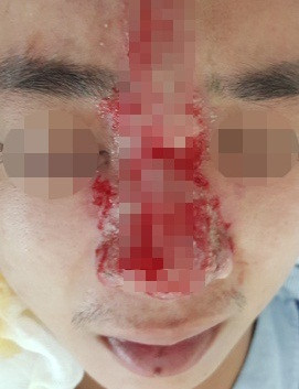 Bệnh nhân gặp biến chứng hoại tử da mũi, mắt bị mờ - Ảnh: BVCC