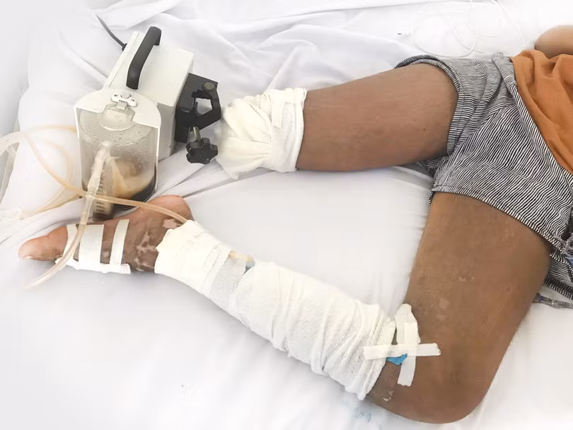 Bệnh nhi bị cắt chân vì cách chữa trị rắn cắn sai lầm.