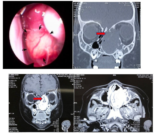 Hình ảnh nội soi và CT scan khối u lớn vùng hốc mũi trái. Ảnh: BVCC Hình ảnh nội soi và CT scan khối u lớn vùng hốc mũi trái. Ảnh: BVCC
