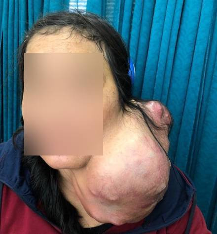 Bệnh nhân mang khối u trên cổ nặng 3kg. Ảnh: BVCC