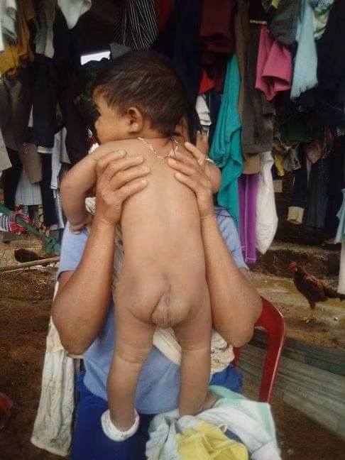 Ngay từ khi sinh ra, em đã mang một khối u lớn ở vùng mông nên dù 7 tháng tuổi vẫn không thể ngồi như những em bé khác