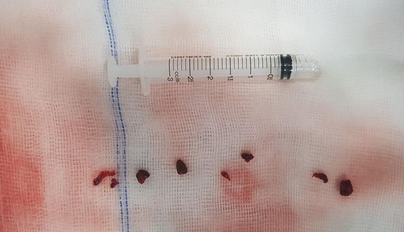 Huyết khối gây tắc mạch máu não của bệnh nhân T. T.A Huyết khối gây tắc mạch máu não của bệnh nhân T. T.A