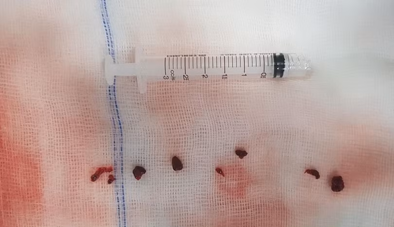 Huyết khối gây tắc mạch máu não của bệnh nhân T. T.A