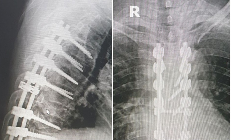 Hình ảnh chụp X quang kết quả phẫu thuật bắt vít kết hợp xương làm cứng cột sống ngực cho bệnh nhân. Ảnh: BVCC