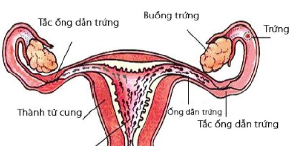 Các bệnh lý phụ khoa dẫn là một trong những nguyên nhâm thầm lặng dẫn đến vô sinh hiếm muộn