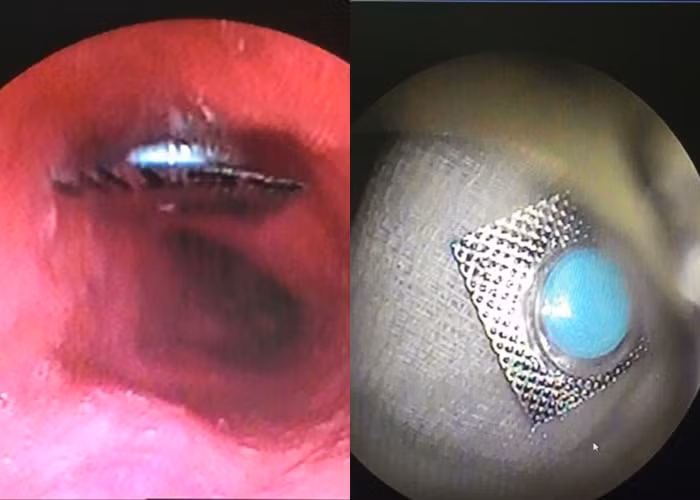 Hình ảnh nôi soi cho thấy viên thuốc còn nguyên vỏ trong bụng bệnh nhân. Ảnh: BV