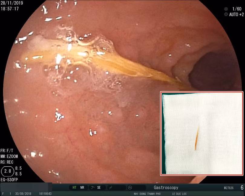 Hình ảnh nội soi cho thấy cây tăm rất mỏng, dài 5cm, nằm dọc và đã di chuyển đến tá tràng