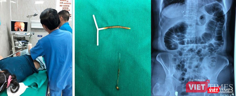 Dị vật là vòng tránh thai đã được lấy ra khỏi đại tràng bệnh nhân. Ảnh: BVCC