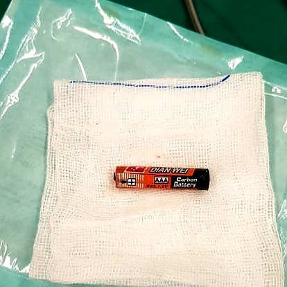 Viên pin con ó được lấy ra khỏi bụng bé gái 4 tuổi. Ảnh: BVCC