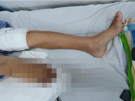 Hình ảnh chân bé trai sau khi đã phẫu thuật thành công. Ảnh: BSCC