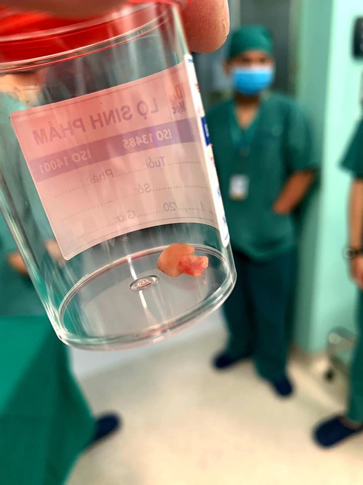 Dị vật được lấy ra khỏi đường thở của trẻ. Ảnh: BVCC