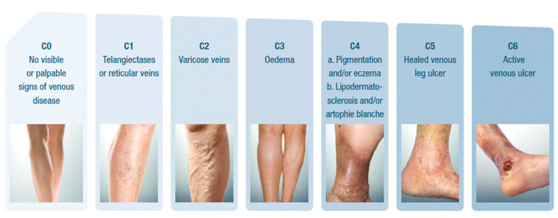 Bệnh suy tĩnh mạch có 6 giai đoạn. Ảnh: Jobst Bệnh suy tĩnh mạch có 6 giai đoạn. Ảnh: Jobst