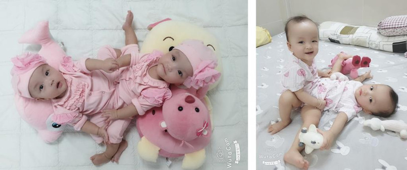 Hình ảnh Trúc Nhi - Diệu Nhi trước khi đại phẫu tách rời. Ảnh: BVCC