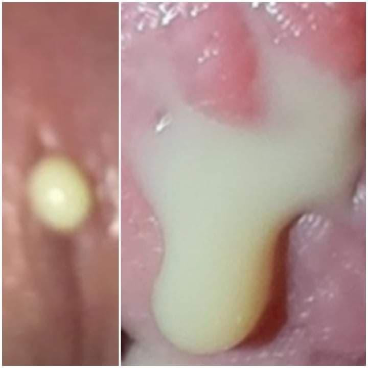 Hình ảnh mủ niệu đạo do lậu gây ra