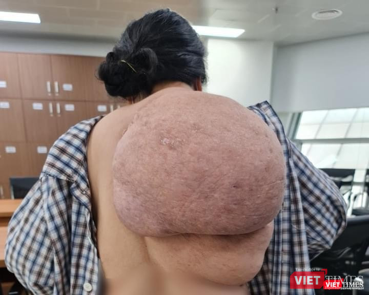 Nỗi khổ của người phụ nữ phải chung sống với khối u khổng lồ (Ảnh: BVCC)