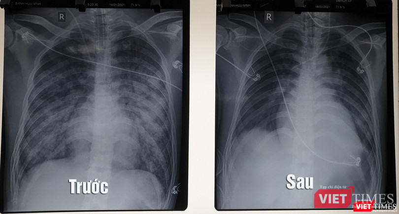 Hình ảnh X quang phổi của bệnh nhân trước và sau khi điều trị bằng kỹ thuật ECMO (Ảnh: BVCC) Hình ảnh X quang phổi của bệnh nhân trước và sau khi điều trị bằng kỹ thuật ECMO (Ảnh: BVCC)