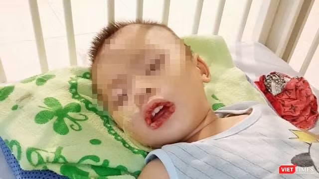 Bé trai không may bị uống nhầm thuốc tẩy bồn cầu, dẫn tới loét miệng và thực quản, dạ dày (Ảnh: BVCC) 