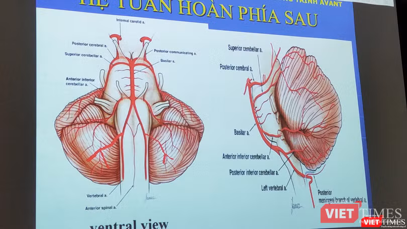 BS Nguyễn Bá Thắng – Trưởng khoa Thần kinh, BV Đại học Y Dược TP.HCM nhấn mạnh chẩn đoán định khu tổn thương rất quan trọng (Ảnh: Hoà Bình)