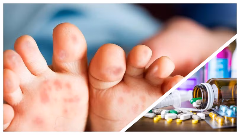 Có thông tin cho rằng thiếu thuốc điều trị bệnh tay chân miệng đang vào mùa cao điểm ở TP.HCM (Ảnh CarePlus, Hòa Bình ghép) 