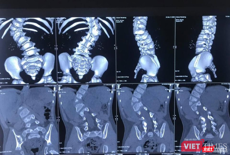 Hình ảnh X quang ca cong vẹo cột sống của bệnh nhi 3 tuổi (BVCC)
