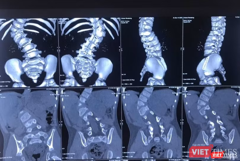 Hình ảnh X quang ca cong vẹo cột sống của bệnh nhi 3 tuổi (BVCC) Hình ảnh X quang ca cong vẹo cột sống của bệnh nhi 3 tuổi (BVCC)