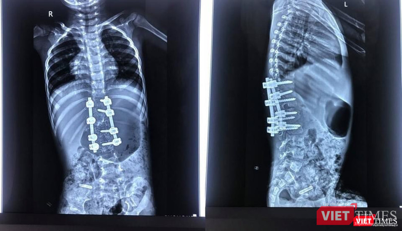 Bác sĩ cho biết sau phẫu thuật biến dạng được nắn chỉnh rất tốt