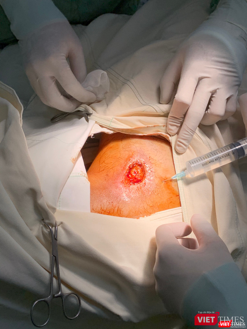 Ảnh chụp vết thương của bệnh nhân do tự thử máy X-quang trước đó, nhập viện vào BV Quốc tế Minh Anh và đang được điều trị (Nguồn: BVCC) Ảnh chụp vết thương của bệnh nhân do tự thử máy X-quang trước đó, nhập viện vào BV Quốc tế Minh Anh và đang được điều trị (Nguồn: BVCC)