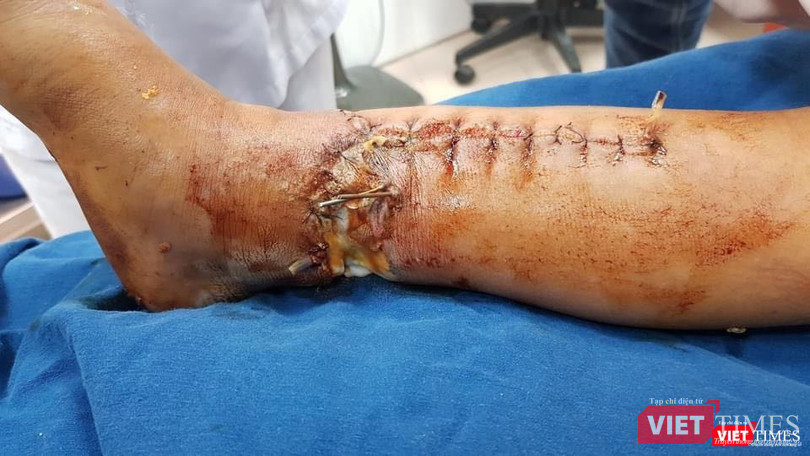 Phần cẳng chân của bé sau khi được tháo băng lần 2 (Ảnh: BVCC)