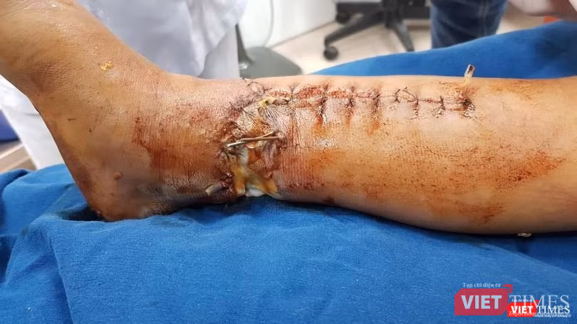 Phần cẳng chân của bé sau khi được tháo băng lần 2 (Ảnh: BVCC)