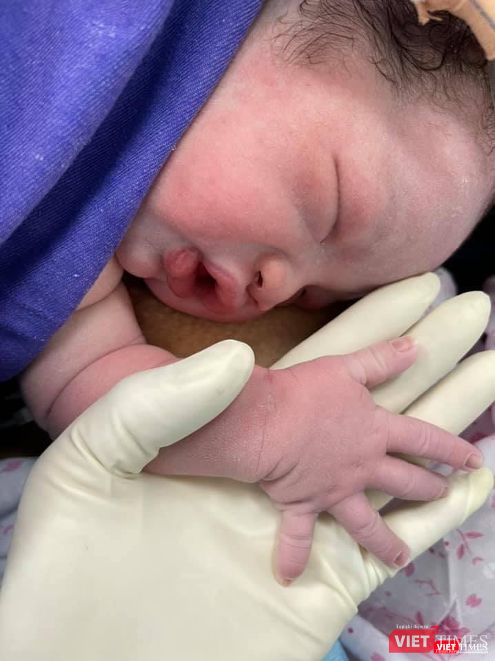 Những em bé được da kề da sau khi sinh (Ảnh: BVCC) Những em bé được da kề da sau khi sinh (Ảnh: BVCC)