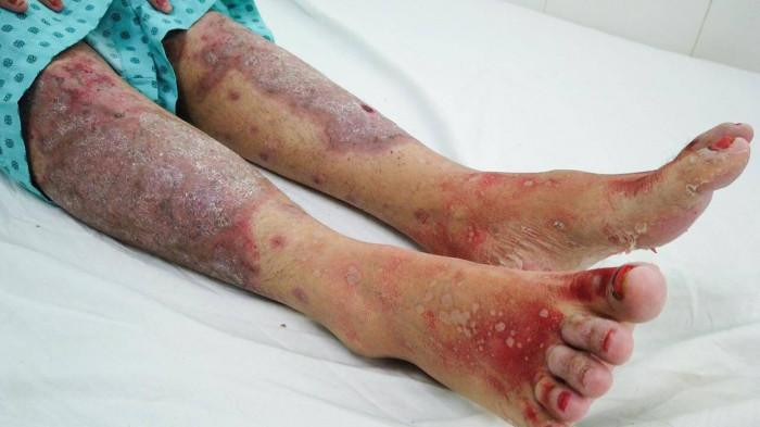 Dấu hiệu hoại tử thượng bì nhiễm độc nặng trên đôi chân người bệnh