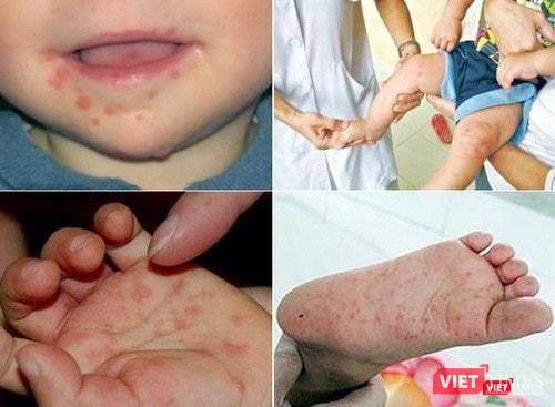 Hiện tại bệnh chưa có thuốc đặc trị, chủ yếu là điều trị triệu chứng