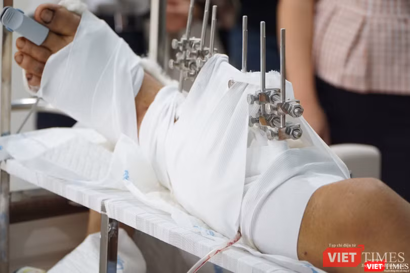 Nhờ cấp cứu kịp thời, BS điều trị tại BV Quân Y 175 đã giữ được chân bị chém đứt lìa của bệnh nhân (Ảnh: BVCC) Nhờ cấp cứu kịp thời, BS điều trị tại BV Quân Y 175 đã giữ được chân bị chém đứt lìa của bệnh nhân (Ảnh: BVCC)