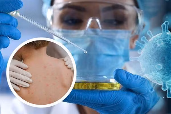 Da nổi mụn khi nhiễm bệnh đậu mùa khỉ Da nổi mụn khi nhiễm bệnh đậu mùa khỉ