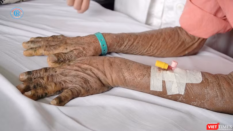 Hai tay của một nạn nhân nhiễm độc thuốc nam điều trị tại Bệnh viện Chợ Rẫy
