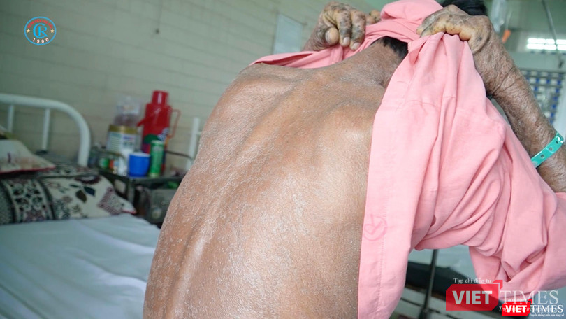 Một bệnh nhân nhiễm độc thuốc nam với triệu chứng khắp người
