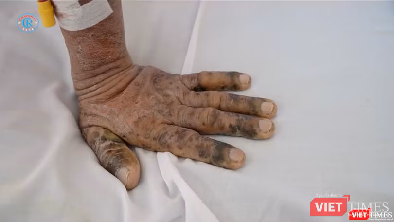 Bàn tay của một bệnh nhân nhiễm độc thuốc nam