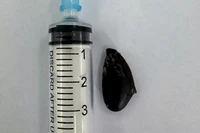 Hạt sapoche kích thước hơn 2 cm đã nằm sâu trong phế quản bệnh nhân suốt 4 tháng được các bác sĩ lấy ra.