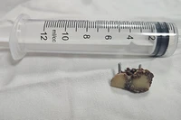 Chiếc răng giả ở trong phổi bệnh nhân 20 năm vừa được các bác sĩ Bệnh viện Đà Nẵng lấy ra.