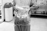 Khối u thận đa nang nặng gần 10 kg được lấy ra từ cơ thể bệnh nhân.