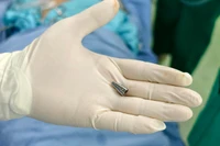 Dị vật là đầu bút được lấy ra từ phế quản bệnh nhân.