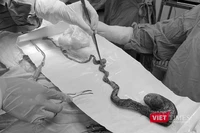 Bóc bỏ búi tóc khổng lồ chiếm hết dạ dày và kéo dài xuống ruột non vừa được các bác sĩ Bệnh viện Phụ sản - Nhi Đà Nẵng lấy ra từu dạ dày bệnh nhi 6 tuổi.