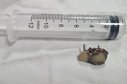 Chiếc răng giả ở trong phổi bệnh nhân 20 năm vừa được các bác sĩ Bệnh viện Đà Nẵng lấy ra.