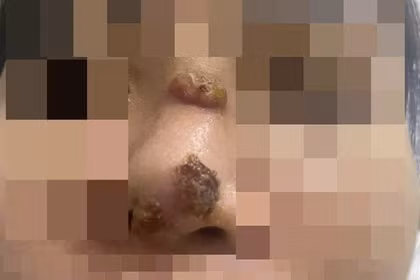 Mũi chị L. bị biến chứng mưng mủ, chảy dịch sau thời gian nâng mũi bằng silicon.Ảnh BVCC