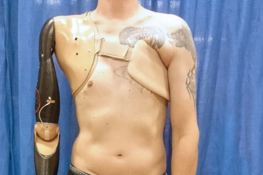 Cánh tay giả mà các đầu thu tín hiệu được kết nối với các cơ ngực