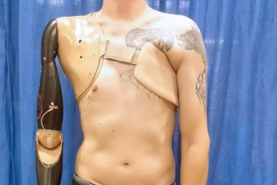 Cánh tay giả mà các đầu thu tín hiệu được kết nối với các cơ ngực