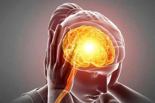 Châm cứu làm giảm số ngày đau của bệnh đau đầu căng thẳng mãn tính. Ảnh SciTechDaily