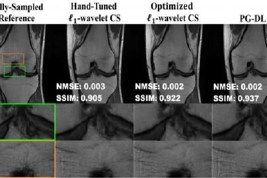 Đại học Minnesota Twin Cities đưa ra giải pháp nâng cao hiệu suất cho phép chụp MRI nhanh hơn không sử dụng các phương pháp học sâu mới hơn. Ảnh: Phòng thí nghiệm xử lý hình ảnh và hình ảnh y tế thông minh, Đại học Minnesota