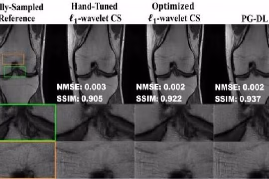 Đại học Minnesota Twin Cities đưa ra giải pháp nâng cao hiệu suất cho phép chụp MRI nhanh hơn không sử dụng các phương pháp học sâu mới hơn. Ảnh: Phòng thí nghiệm xử lý hình ảnh và hình ảnh y tế thông minh, Đại học Minnesota